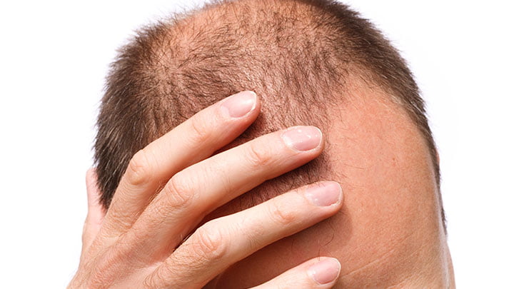 não ficar careca